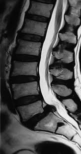 Bel Kayması (Lomber Spondylolistezis)