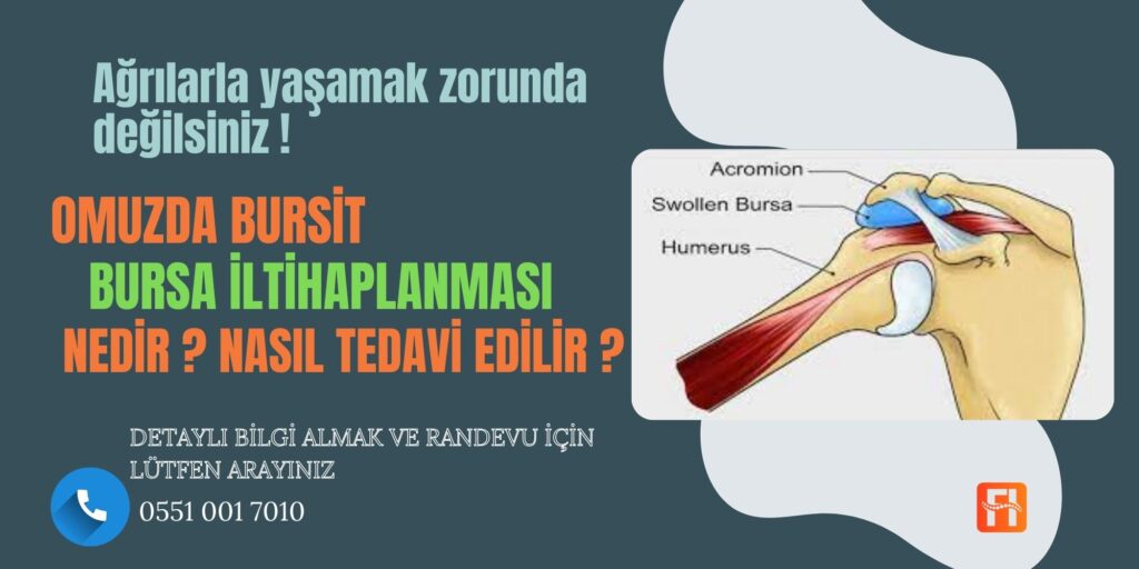Omuz Bursiti  (Omuz Bursa İltihaplanması)