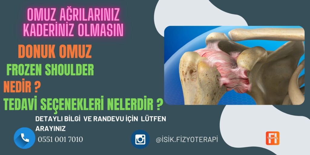 Donuk Omuz (Frozen Shoulder) Nedir