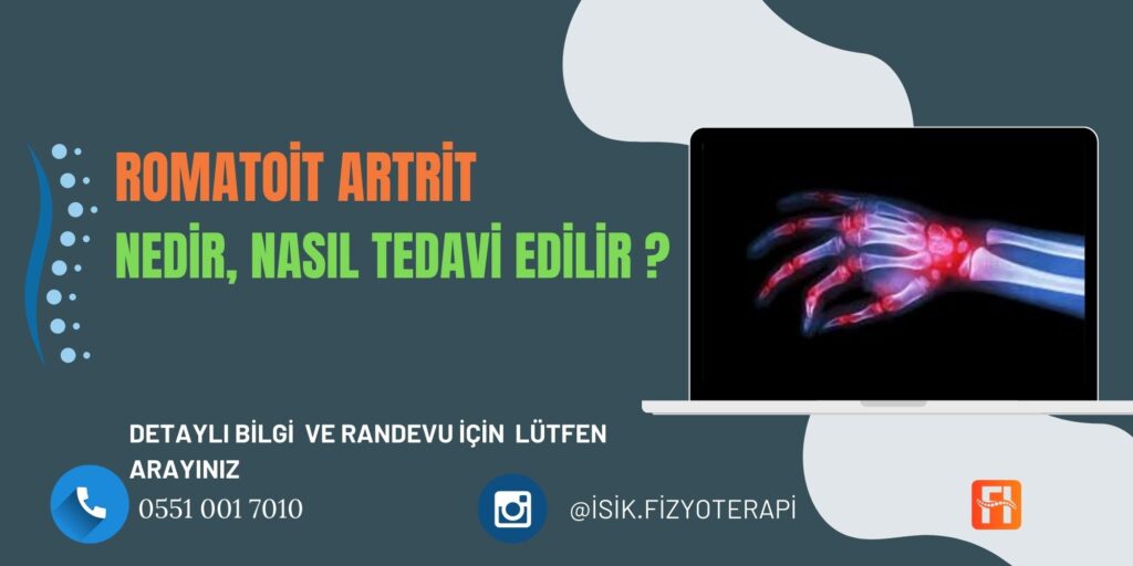 Romatoit Artrit