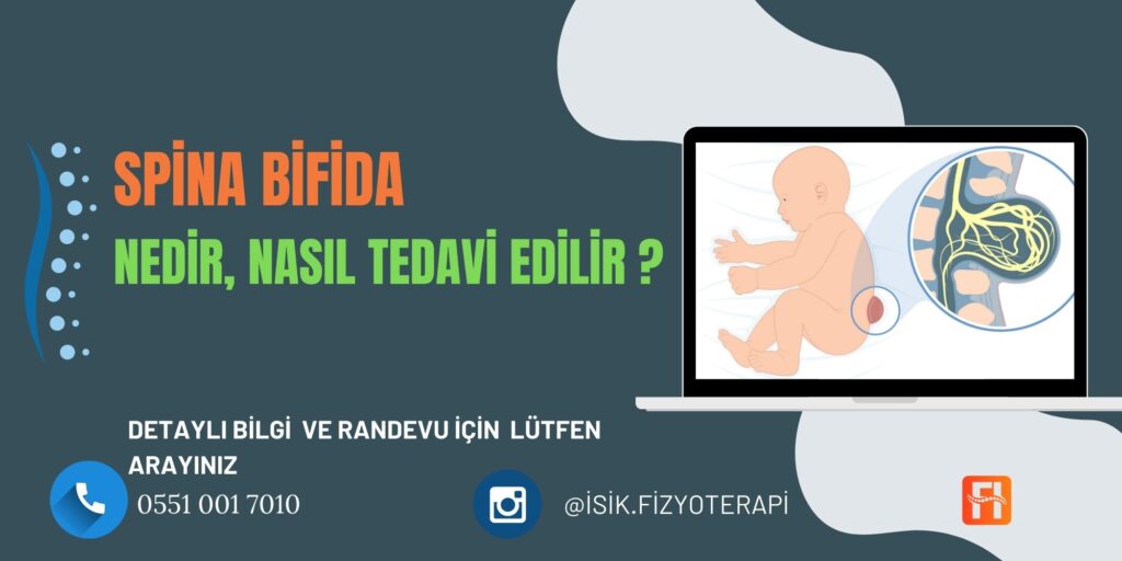 Spina Bifida